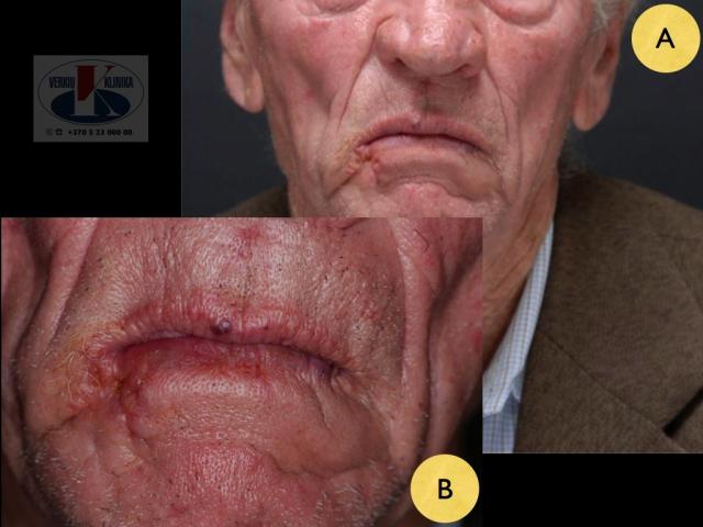 Lūpos plokščialąstelinis vėžys: pacientas po gydymo
