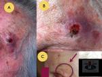 Plokščialąstelinis odos vėžys