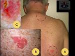 Plokščialąstelinis odos vėžys (morbus Boweni) aktininės keratozės fone