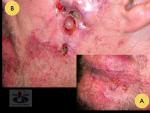 Plokščialąstelinis odos vėžys išsivystęs po trumpažidininio spindulinio gydymo dėl "Portveino dėmės"