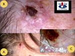 Plokščialąstelinis odos vėžys aktininės keratozės fone