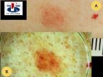 Plokščialąstelinis odos vėžys (morbus Boweni)