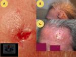 Skleroderma. Plokščialąstelinis odos vėžys