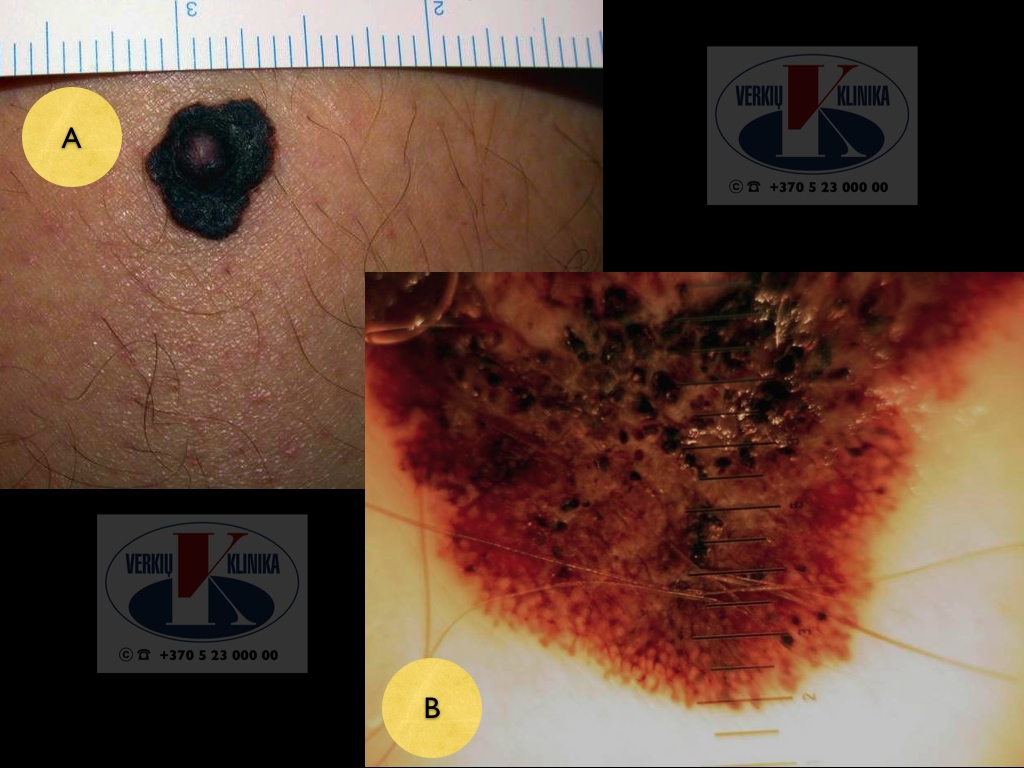 Mazginė melanoma, A. Breslow 2,6 mm