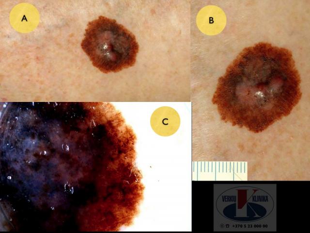 Mazginė melanoma,  A. Breslow 2,3 mm