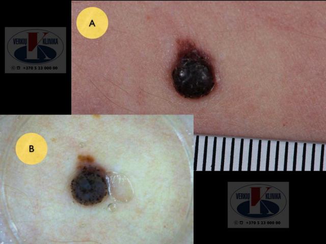 Mazginė melanoma, A.Breslow 2,0 mm