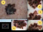 Paviršiumi plintanti (radialinė) melanoma, A. Breslow 0,4  mm