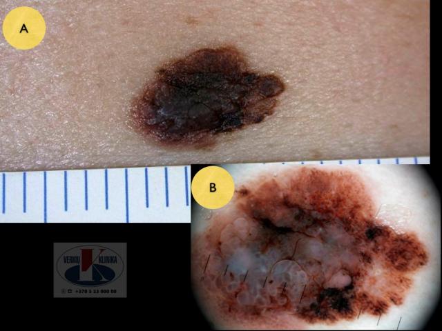 Paviršiumi plintanti (radialinė) melanoma,  A. Breslow 1,5 mm