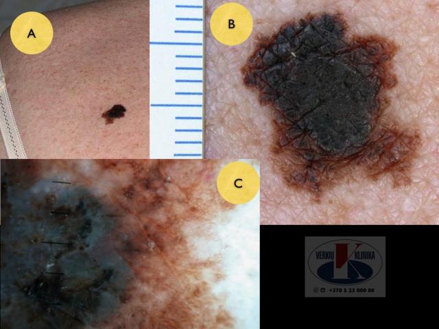Paviršiumi plintanti (radialinė) melanoma, A. Breslow 0,5 mm