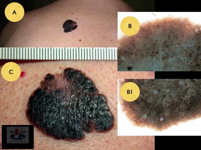 Paviršiumi plintanti  (radialinė) melanoma, A. Breslow 0,3 mm