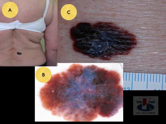 Paviršiumi plintanti (radialinė) melanoma