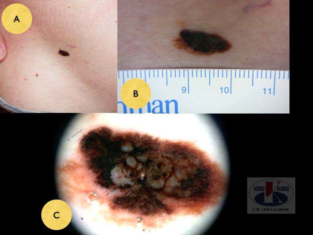 Paviršiumi plintanti  (radialinė) melanoma, A. Breslow 0,5 mm