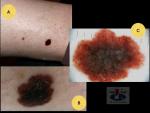 Paviršiumi plintanti (radialinė) melanom:a, A. Breslow 1,1 mm
