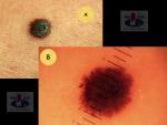 Paviršiumi plintanti (radialinė) melanoma, A. Breslow: melanoma in situ (Tis)