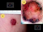 Mazginė melanoma, A. Breslow 1,0 mm