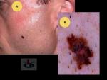Paviršiumi plintanti  (radialinė) melanoma, A. Breslow  0,7 mm