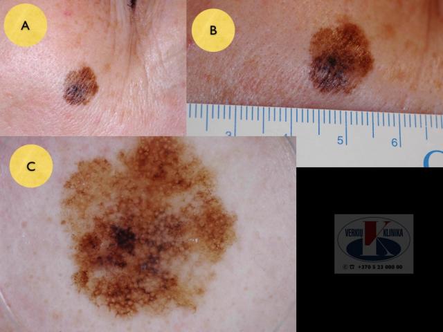 Lentigo melanoma, A. Breslow: melanoma in situ (Tis)