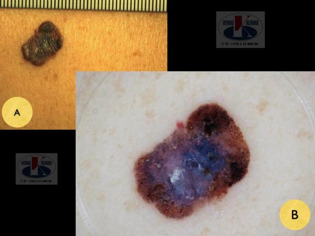 Paviršiumi plintanti (radialinė) melanoma,  A. Breslow 0,5 mm