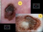 Akralinė melanoma, A. Breslow 2,0 mm