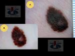 Akralinė melanoma,  A. Breslow 0,7 mm