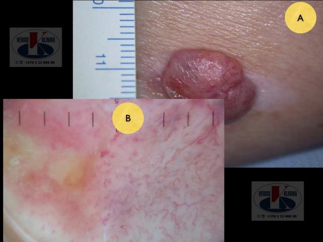 Amelanotinė mazginė melanoma