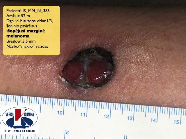  Išopėjusi mazginė melanoma, A. Breslow 3,5 mm