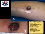  Išopėjusi mazginė melanoma, A. Breslow 3,5 mm