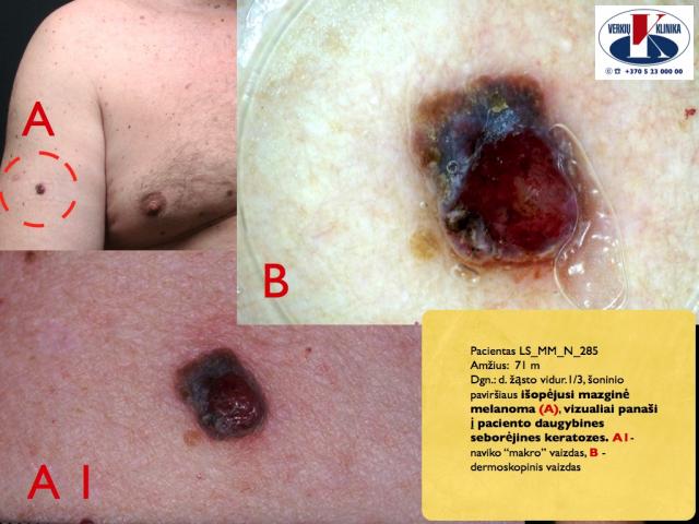 Išopėjusi mazginė melanoma