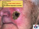 Lentigo maligna melanoma, A. Breslow 1,0 mm