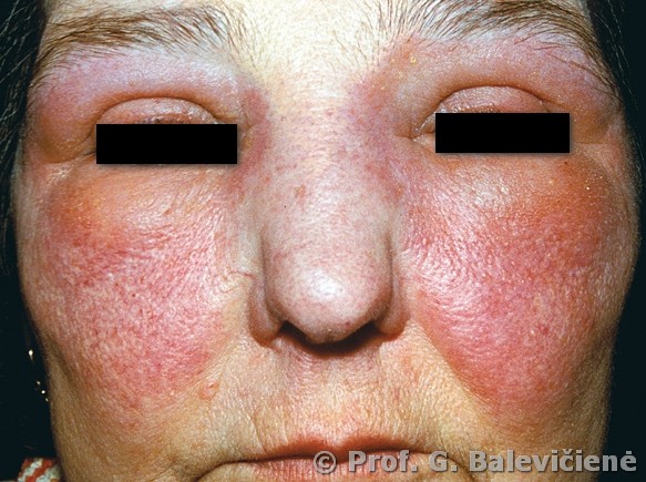 Alerginis kontaktinis dermatitas
