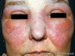Alerginis kontaktinis dermatitas