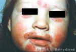 Atopinis dermatitas (egzema aplink burną )  