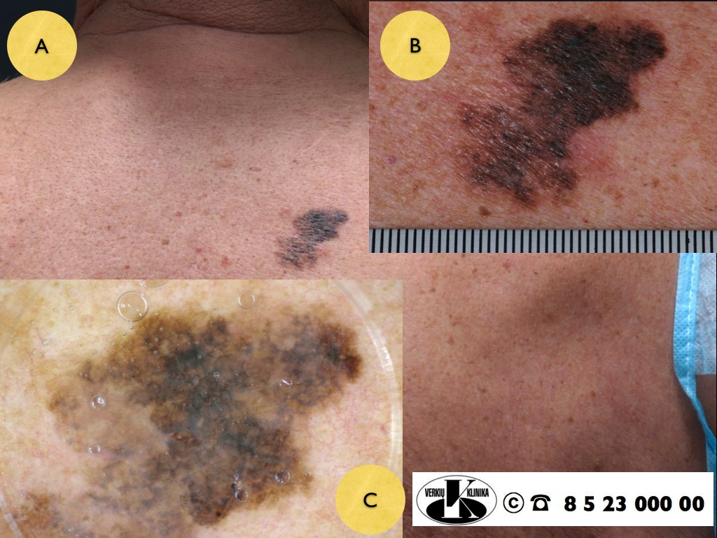 Lentigo melanoma, A. Breslow: melanoma in situ (Tis)
