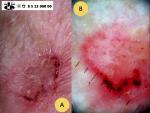 Plokščialąstelinis odos vėžys (morbus Boweni)